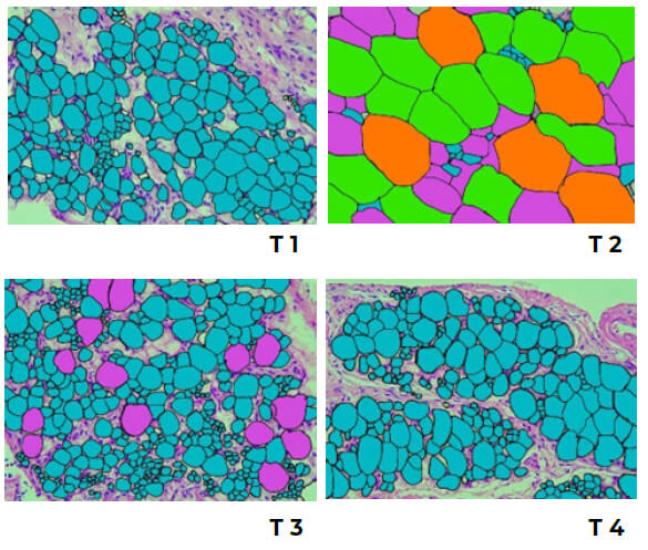 Figura 2: Análisis microscópico del tejido adiposo visceral de pollitos Cobb 500 alimentados con dietas conteniendo diferentes fuentes de ácidos grasos. T1: 97% Dieta basal (DB) + 3% material inerte; T2: 97% DB + 3% manteca vegetal parcialmente hidrogenada; T3: 97% DB + 3% aceite de quinua; T4: 97% DB + 3% aceite de pescado. Objetivo 40X (Leica DM750).
